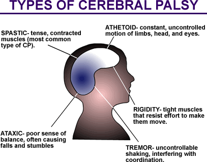 CEREBRAL PALSY