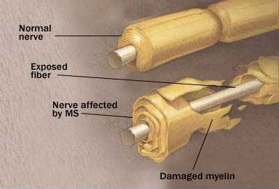 multiple sclerosis