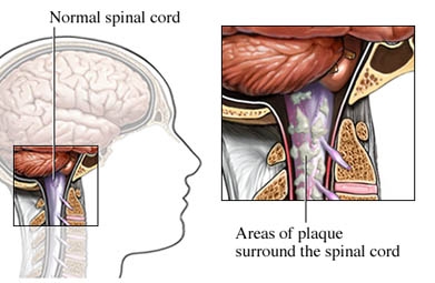 multiple sclerosis