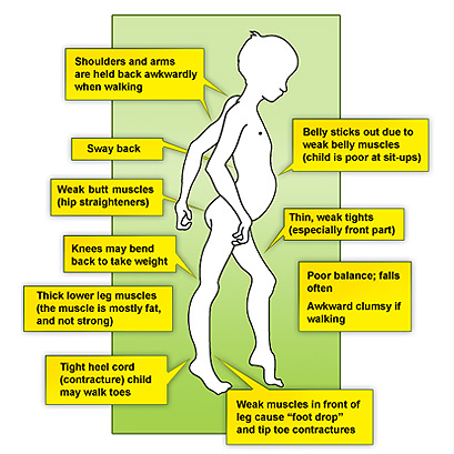 Muscular dystrophy