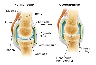 OSTEOARTHRITIS