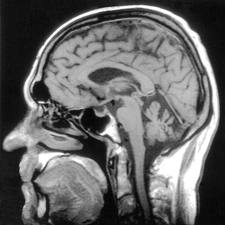 SPINO CEREBELLAR ATAXIA