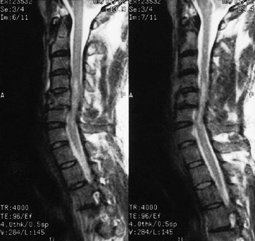 SPINAL CORD INJURY