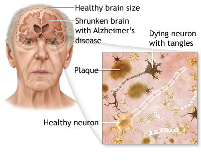 alzheimer's disease