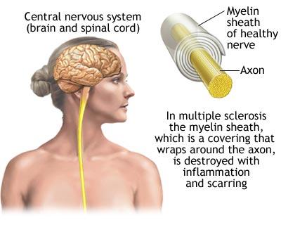multiple sclerosis