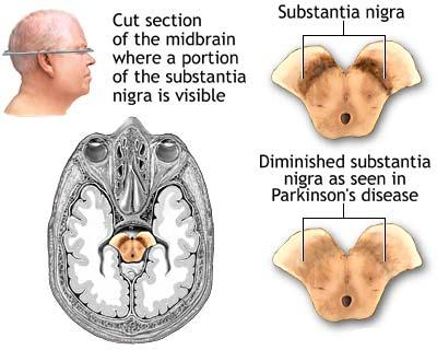 parkinson's disease