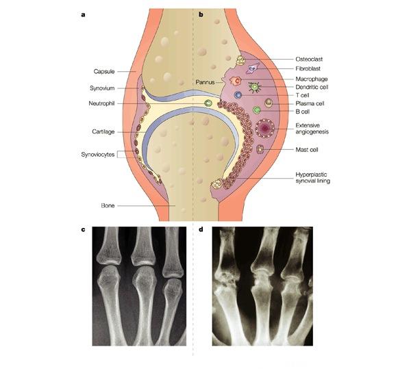 RHEUMATOID ARTHRITIS